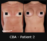 CBA - Patient2